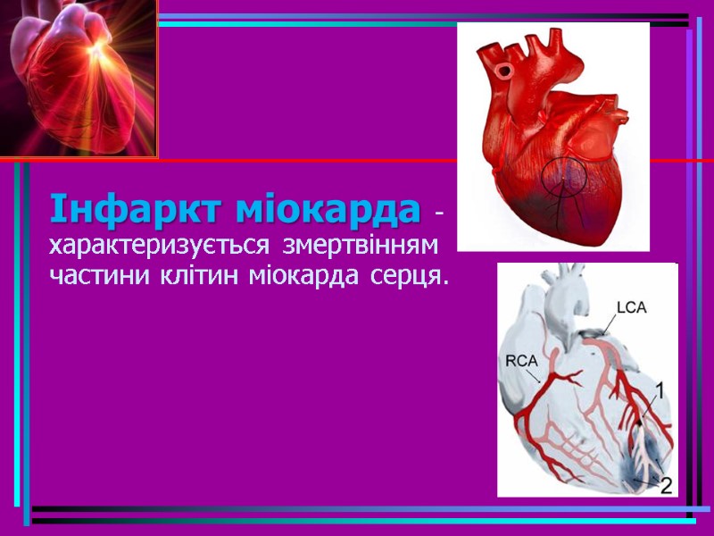 Інфаркт міокарда - характеризується змертвінням частини клітин міокарда серця.